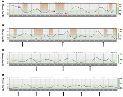 Case report: Better late than never, but sooner is better: switch from CSII to sulfonylureas in two patients with neonatal diabetes due to KCNJ11 variants